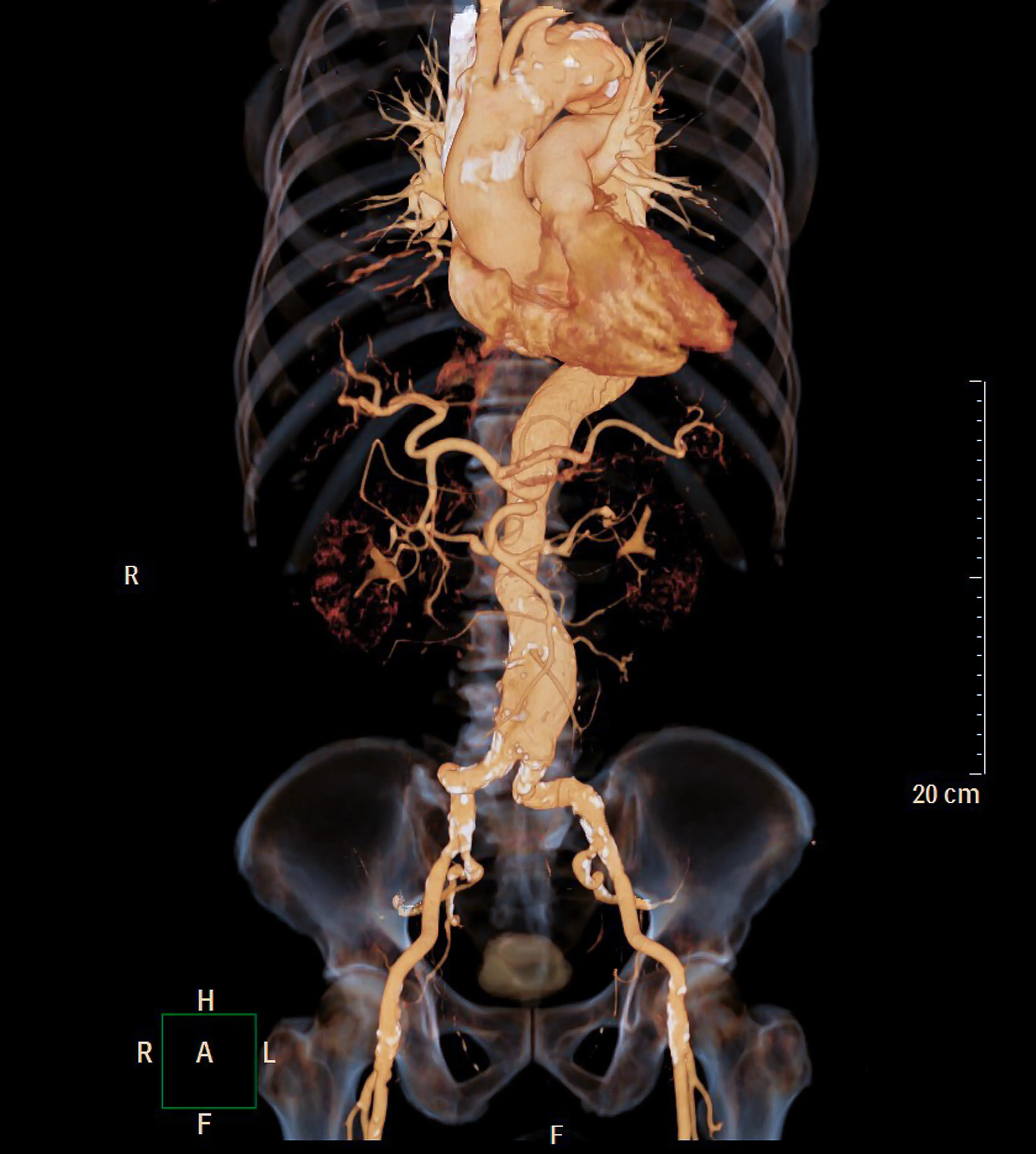 Abdominal Aort Anevrizmasında Risk Hesaplaması