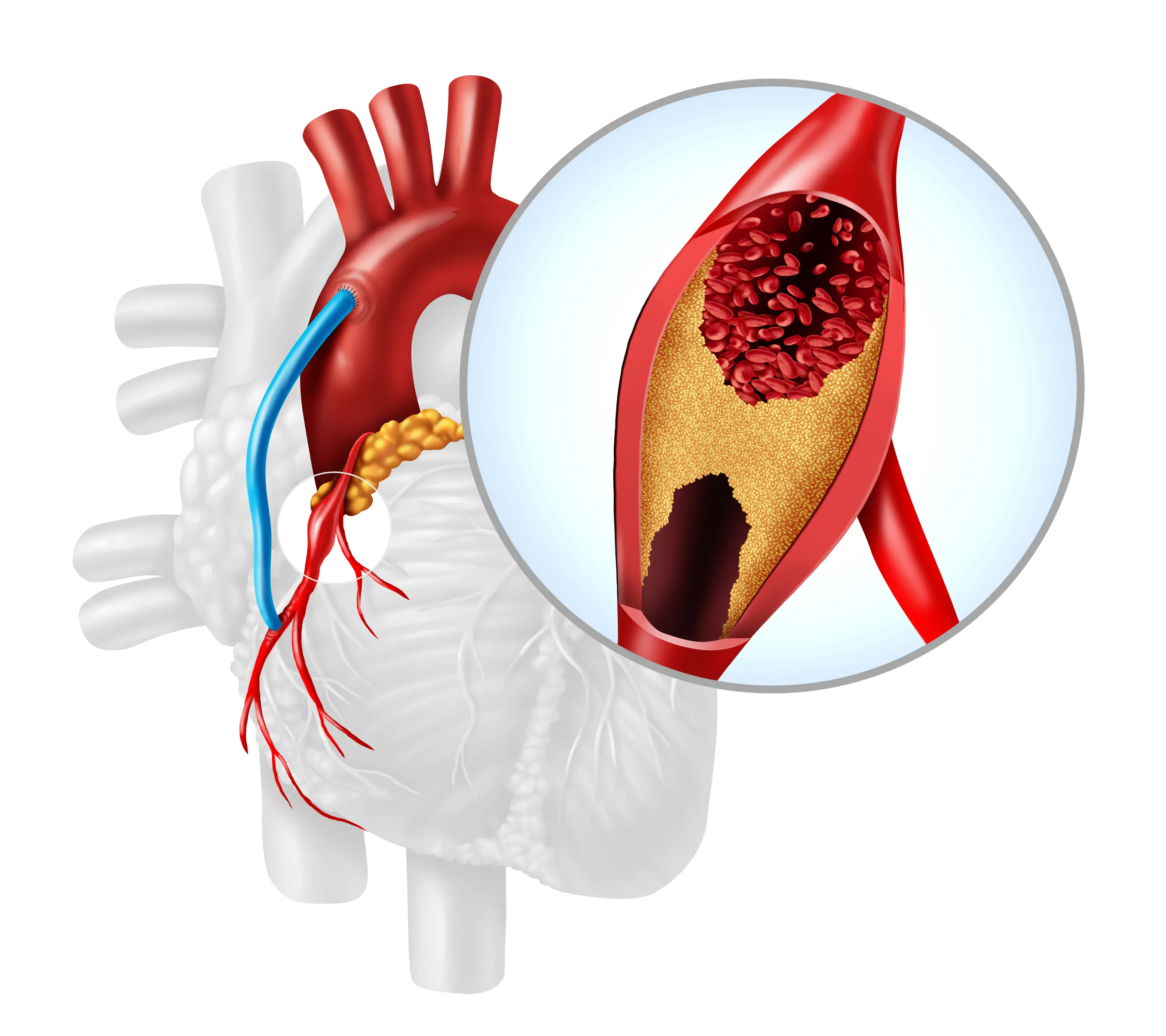 Stent mi yoksa Baypass mı? Kalp Krizinden nasıl korunalım?