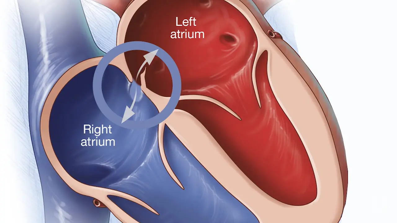 Patent Foramen Ovale: Ne Kadar Tehlikeli?