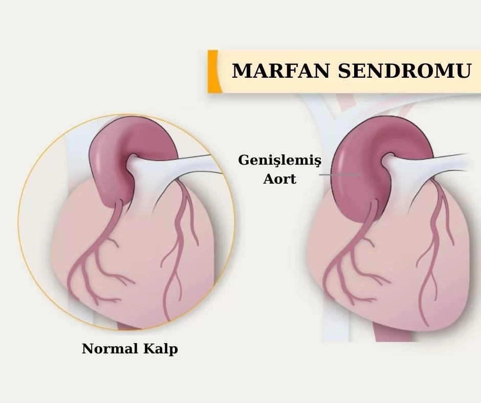Marfan Sendromu ile Yaşamak: Kalp Sağlığı Üzerindeki Etkileri