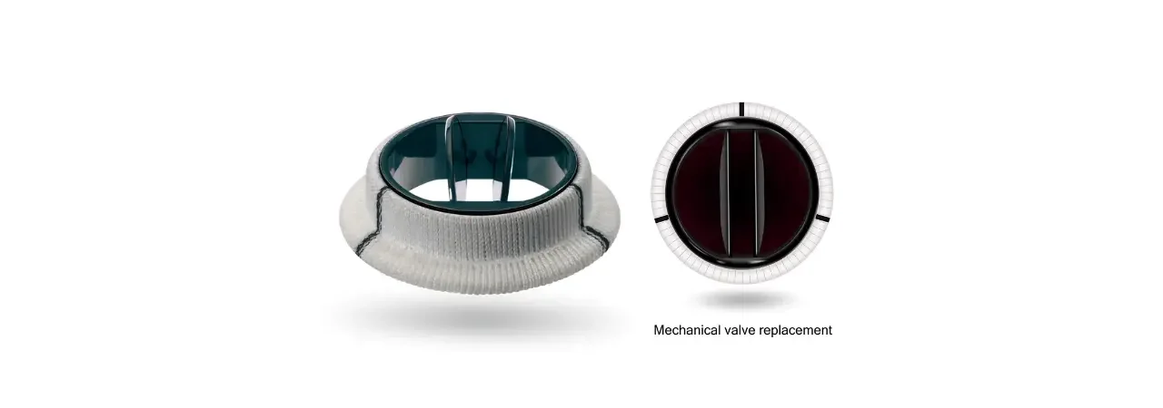 Mekanik Kapak Protezi: Hangi Durumlarda Kullanılır?