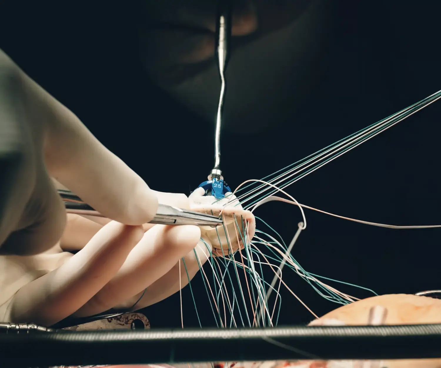 Minimally Invasive Valve Surgery