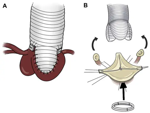 Yacoub Ameliyatı'nın Avantajları ve Dikkat Edilmesi Gerekenler