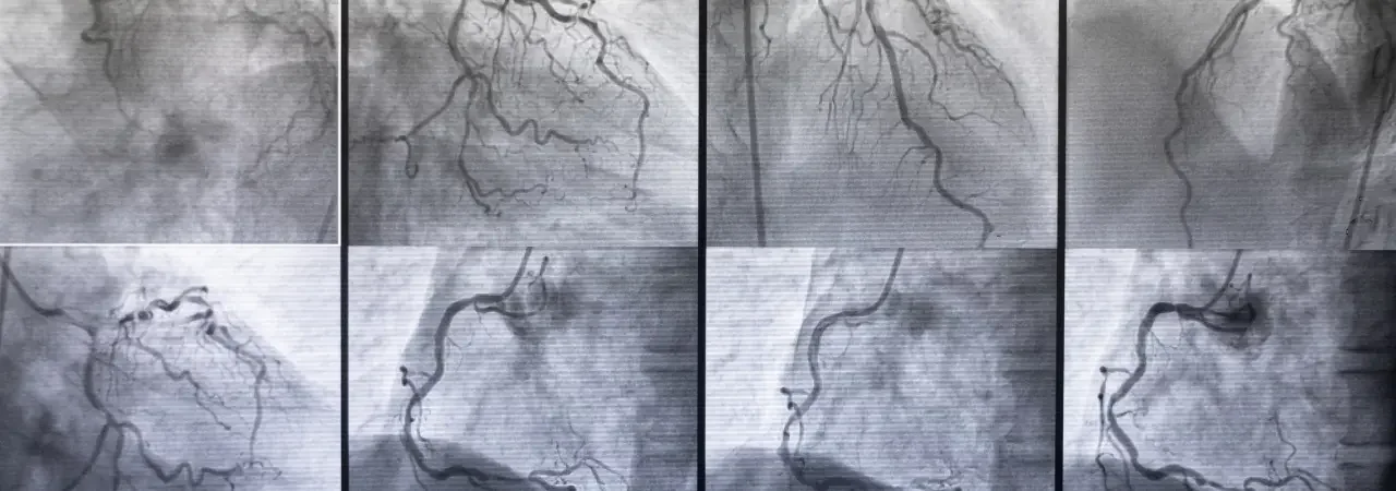 Anjiyografi | Kalp Damar Tıkanıklıklarının Tanısında Altın Standart