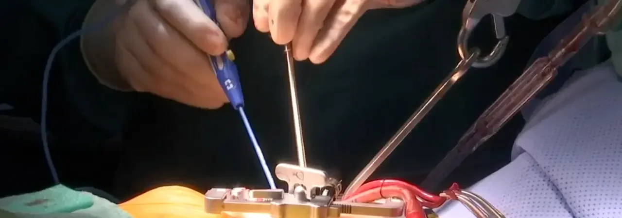 Kapalı Yöntem Bypass: Avantajları ve Dezavantajları